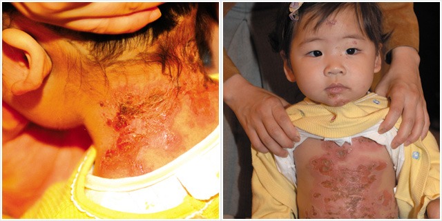 healed of infectious impetigo